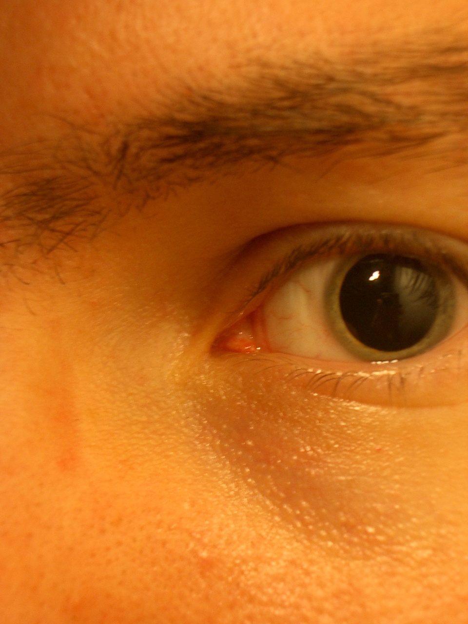 dilation