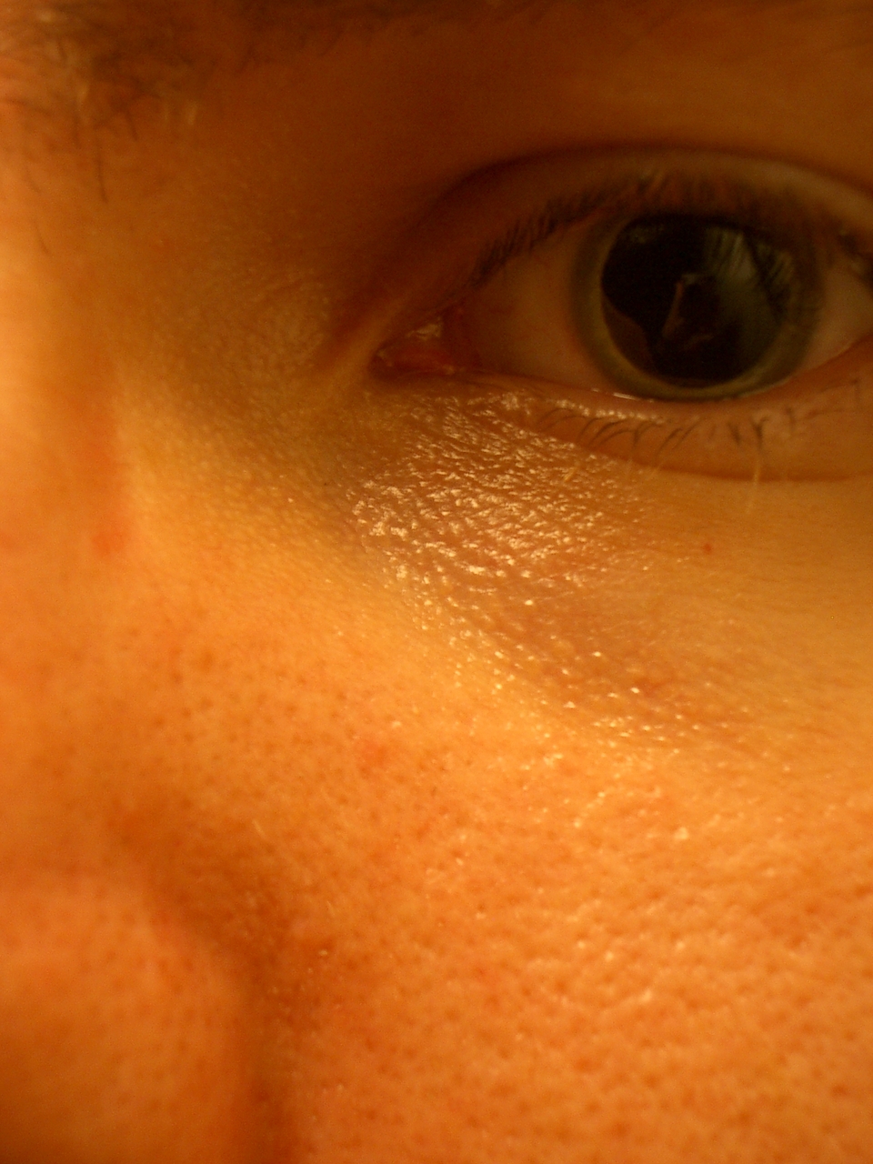 dilation